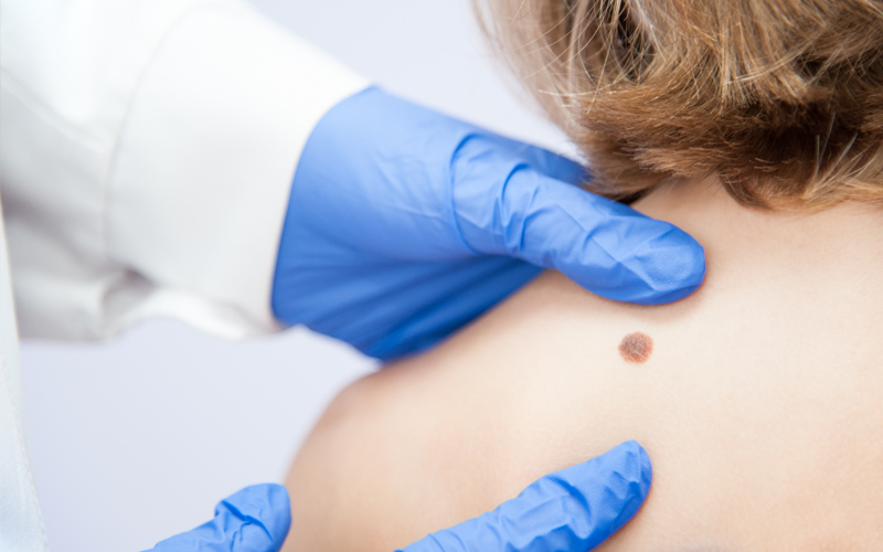 Birthmark Removal