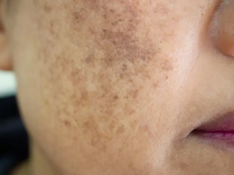 Pigmentation