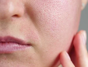 Skin resurfacing