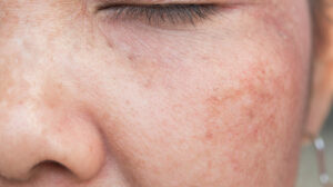 Sun Damaged Skin