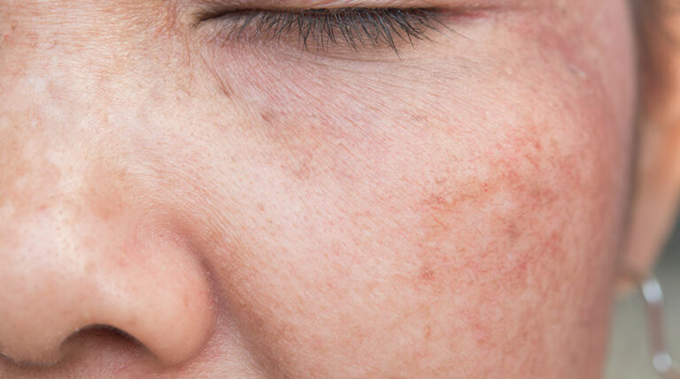 Sun Damaged Skin
