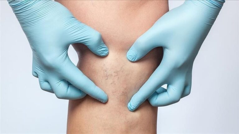 Vascular Lesions treatment