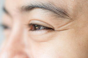 Wrinkles treatment