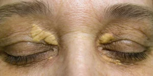 Xanthelasma treatment