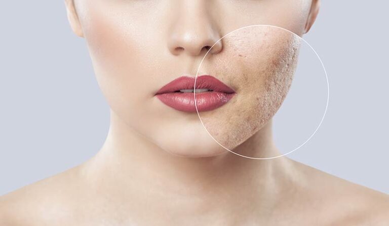 Laser Skin Resurfacing