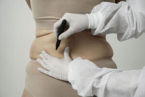 Fat Freezing (Cryolipolysis)