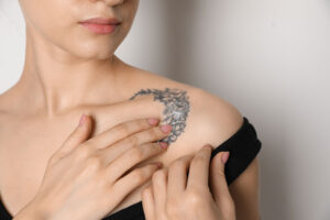 Tattoo Removal