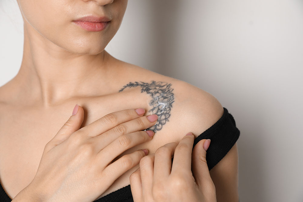 Tattoo Removal