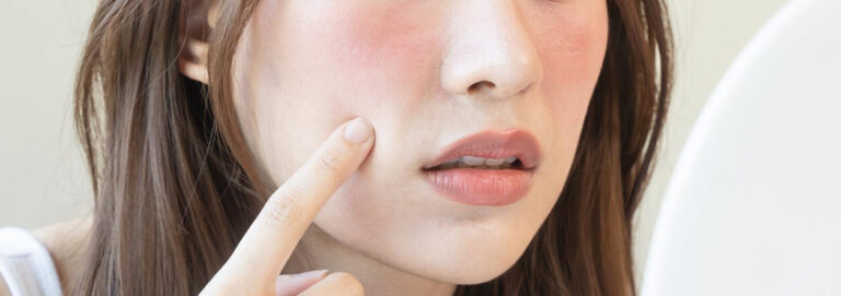 Redness & Sensitive Skin – NeuGlow The Aesthetics Doctors – NeuGlow The Aesthetics Doctors Redness & Sensitive Skin