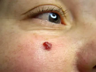 Haemangiomas treatment